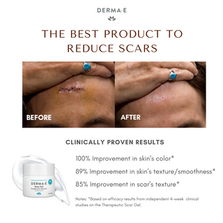 Derma E Scar Gel, 56g